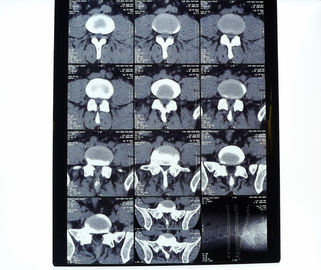 Good price 8in* 10in 14in * 17in υψηλής πυκνότητας ιατρική ταινία θερμικών εκτυπωτών ακτίνας X ξηρά σε απευθείας σύνδεση