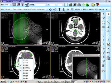8 διαγνωστική απεικόνιση ακτίνας X λέιζερ εγγράφου Χ 10inch ιατρική για knd-DRYTEC 4000