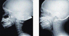 Υψηλή διαγνωστική απεικόνιση ακτίνας X κάλυψης μελανιού, 35 X 43cm ιατρική των ακτίνων X ταινία λέιζερ