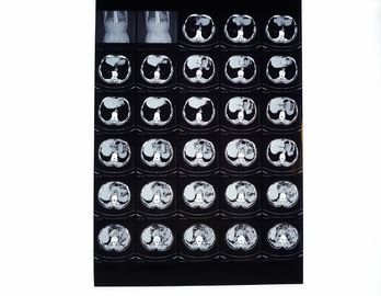 Ιατρικές ταινίες ακτίνας X, ξηρά ταινία απεικόνισης συμβατή με το θερμικό εκτυπωτή για το CT/το ΔΡ/MRI